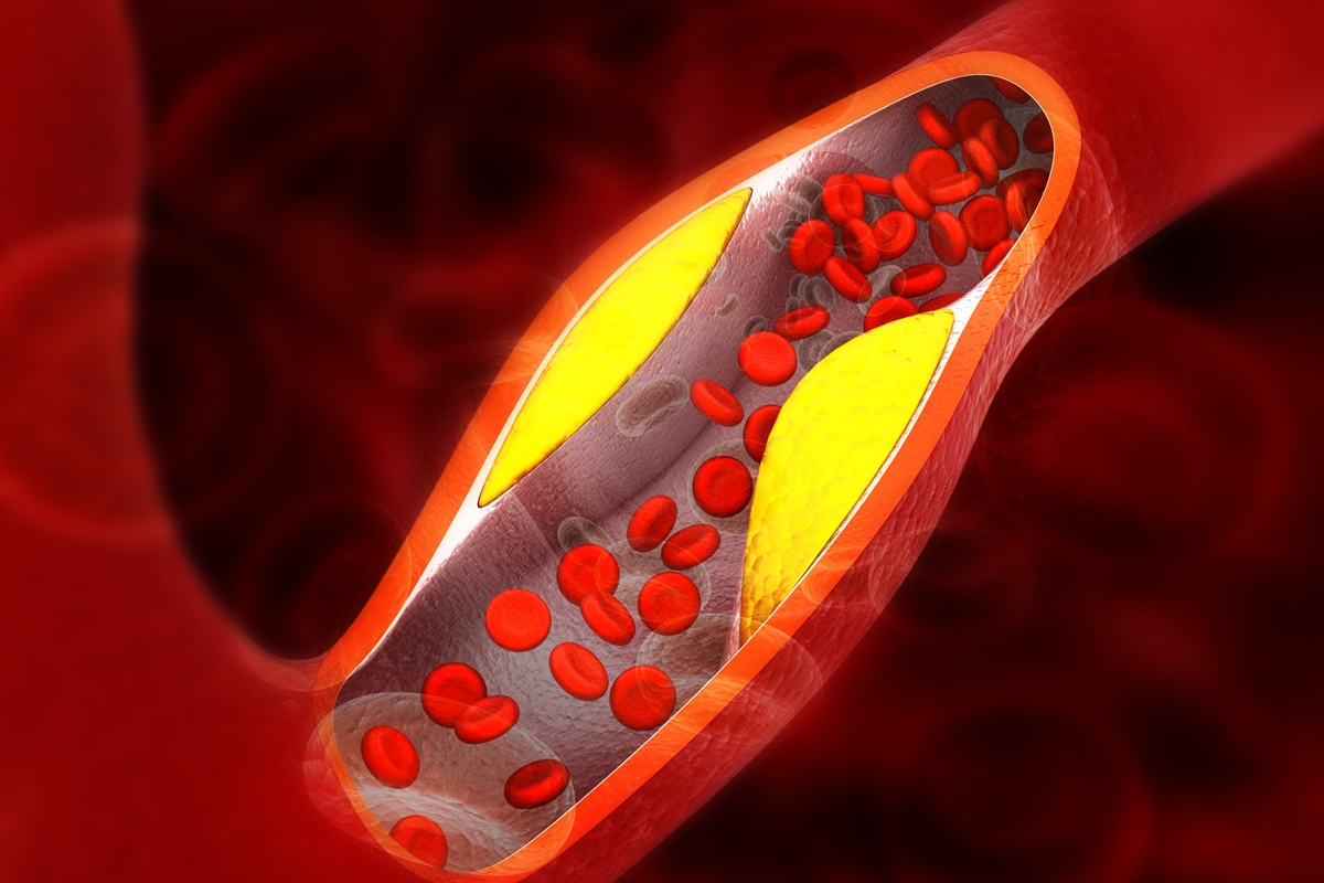 Médico vascular aponta fatores de risco e o que ajuda a prevenir a trombose