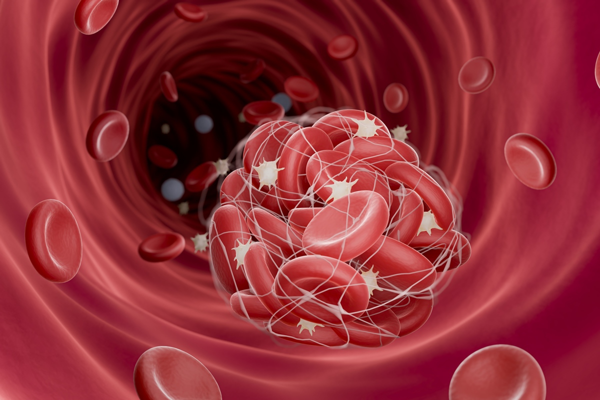 Médico vascular aponta fatores de risco e o que ajuda a prevenir a trombose